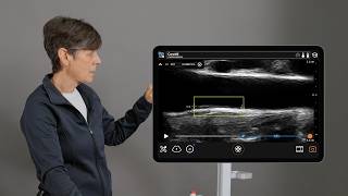 How to Use Clarius Auto IMT for Carotid Artery Ultrasound