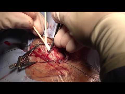 Video: Scleral Buckling: Chirurgia, Podrobnosti O Procedúre A Čas Zotavenia