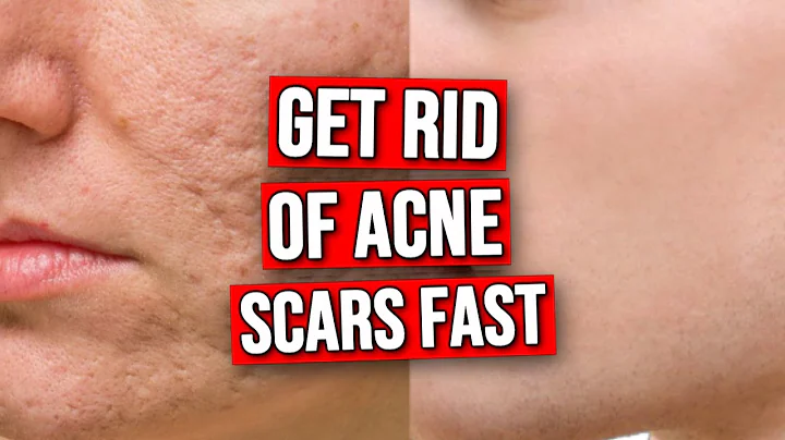 3 DO's & DON'TS To Get Rid of Acne Scars FAST! - DayDayNews