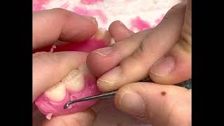 Festooning a wax up