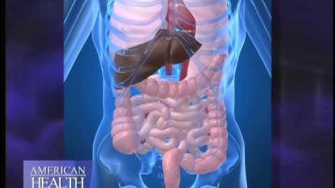 What is Diverticulitis Video