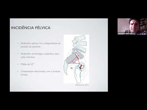 Vídeo: Exploração Do Alinhamento Sagital E Resultados Clínicos Após Cirurgia Híbrida Consecutiva Em Três Níveis E Discectomia E Fusão Cervical Anterior: No Mínimo Em 5 Anos De Acompanhame