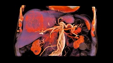 Cinematic Rendering Animation of An Hepatobiliary Tumor