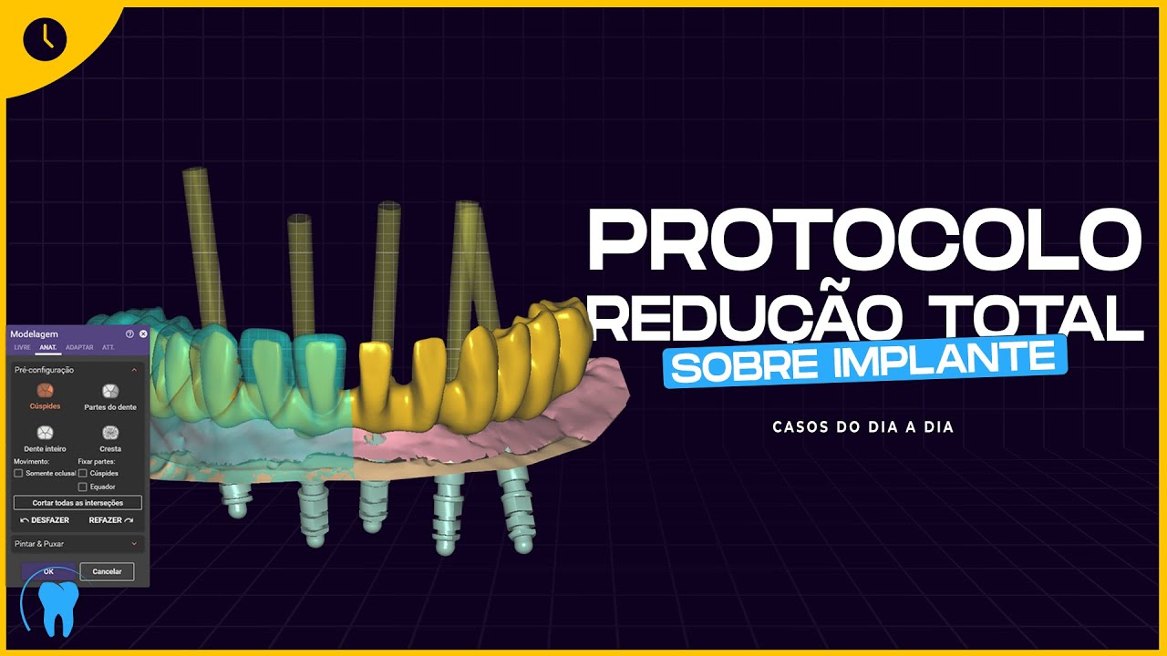 EXOCAD : Protocolo redução total sobre implante