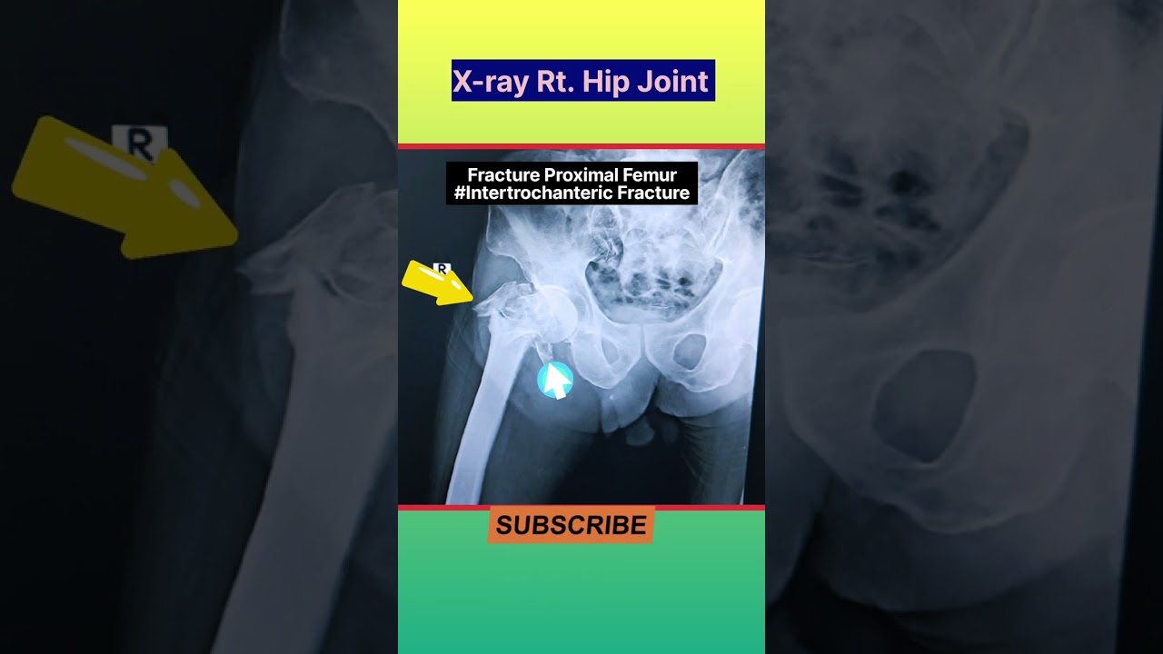 Hip joint Fracture X-Ray 