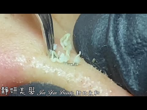 閉鎖粉刺處理(Atresia acne treatment)-Taiwan New Taipei City-台北清粉刺最乾淨