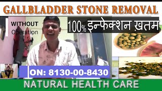 Gallbladder stone treatment without operation | पित्त की थाली की पथरी का सफल इलाज | Dr S C Sharma