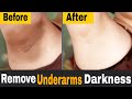 How To Lighten Dark Underarms at Home | Get Rid of Dark Armpits Naturally