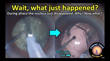 CataractCoach 1021: the nucleus drops during phaco - what happened?