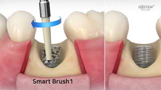 Osstem Implant India offers the IM Cure KIT, which is designed to diagnose & manage peri-implantitis