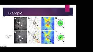 6 Pasos Para Optimizar El Diagnostico De Glaucoma Con El OCT - DR. VITAL COSTA