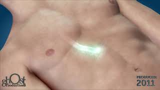 MayoClinic PhotoAblation