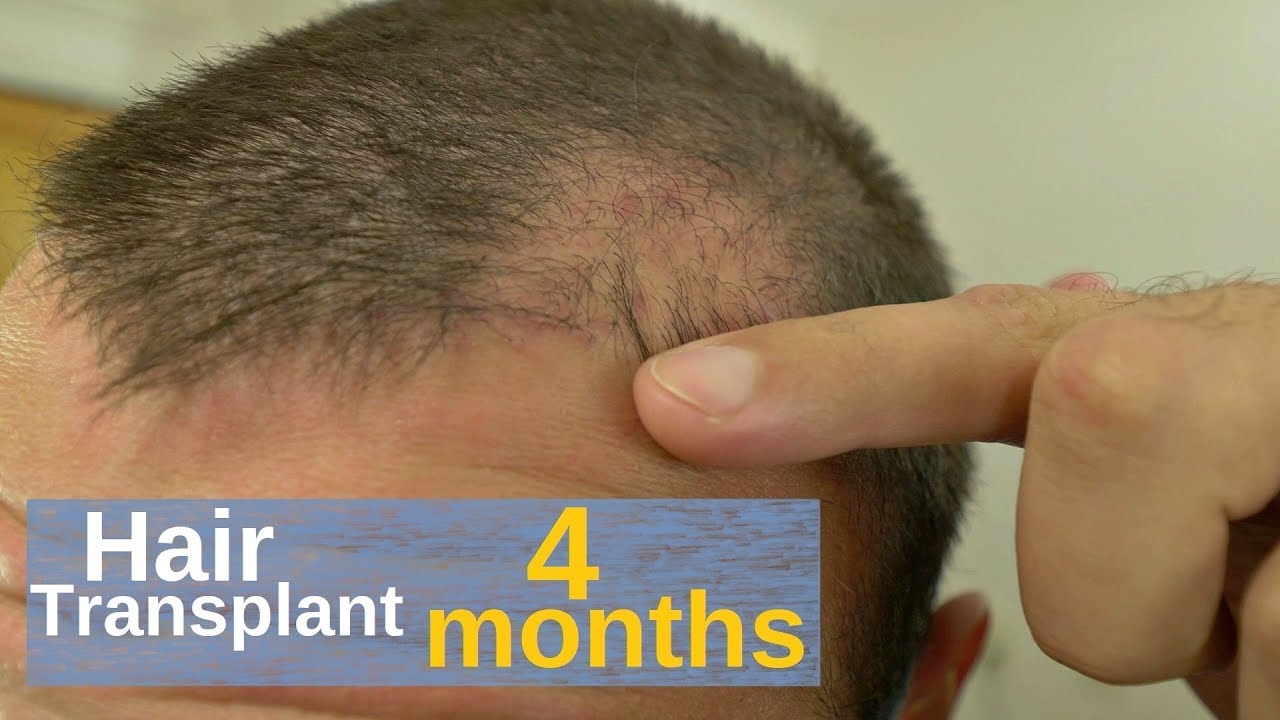 Hair Transplant Progression Photos  AlviArmani  Hair Transplant Los  Angeles