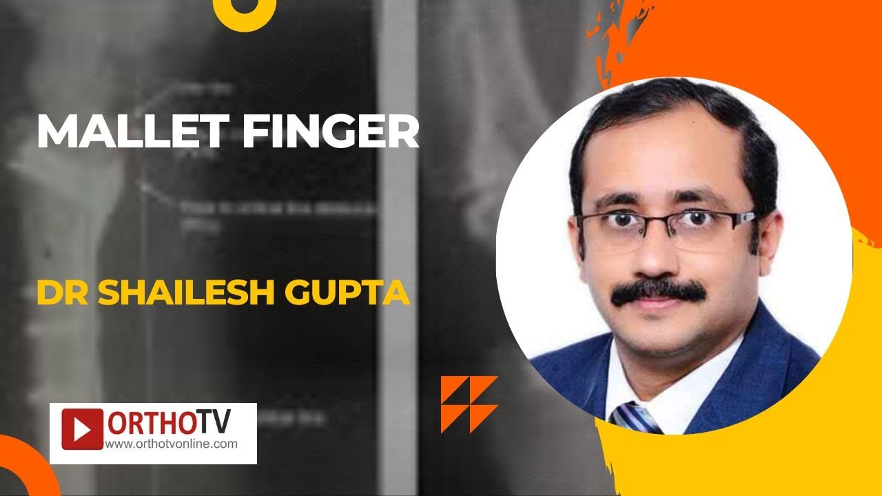 Mallet Finger by Dr Shailesh Gupta YouTube