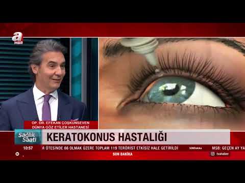 Keratokonus Nasıl Ortaya Çıkar? (Sağlık Saati AHaber, Leyla Ataman)