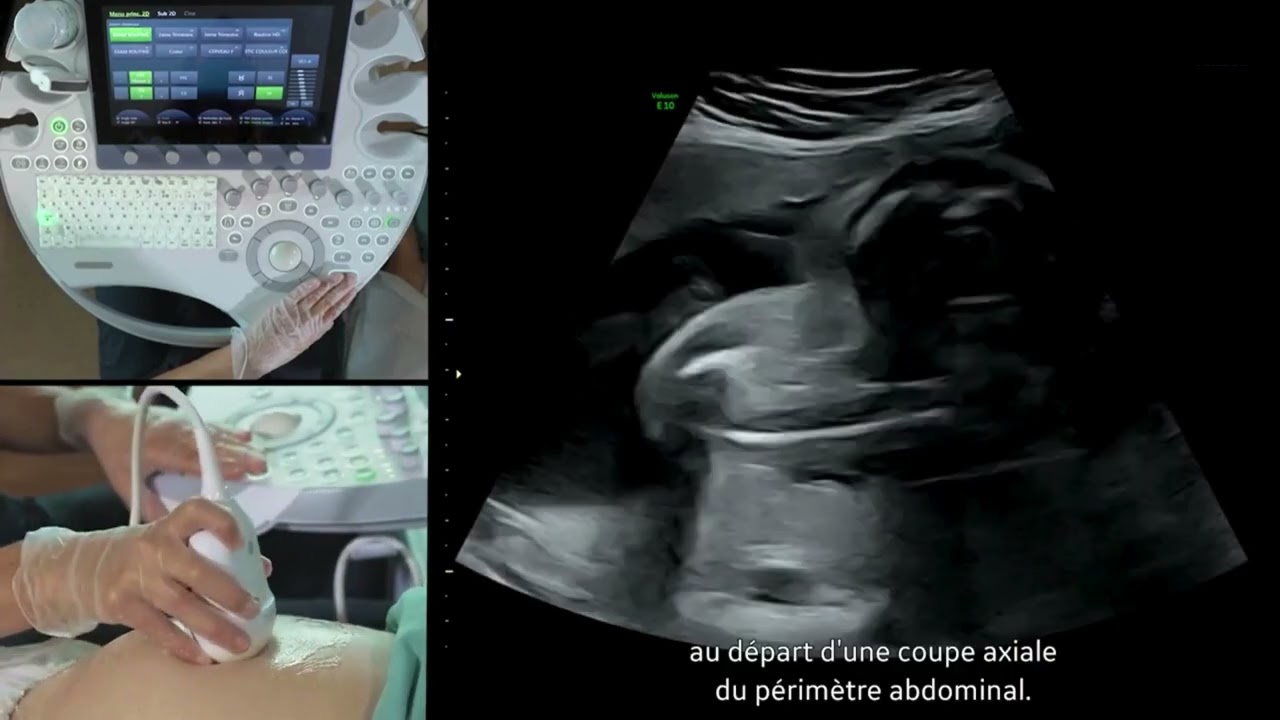 L’échographie de dépistage au 2e et 3e trimestre – examen des membres et la longueur fémorale