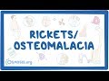 Rickets/osteomalacia - causes, symptoms, diagnosis, treatment, pathology