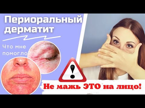 Видео: Как вы лечите кореподобную сыпь?