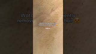 12 months of using Lumi IPL Hair removal  #hairremoval #laserhairremoval #hairremovalmethods