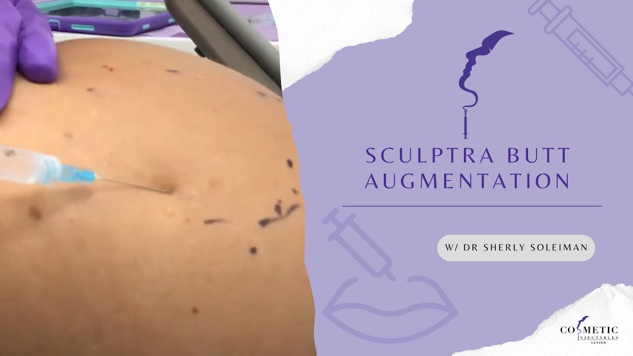 Sculptra Butt Augmentation - YouTube