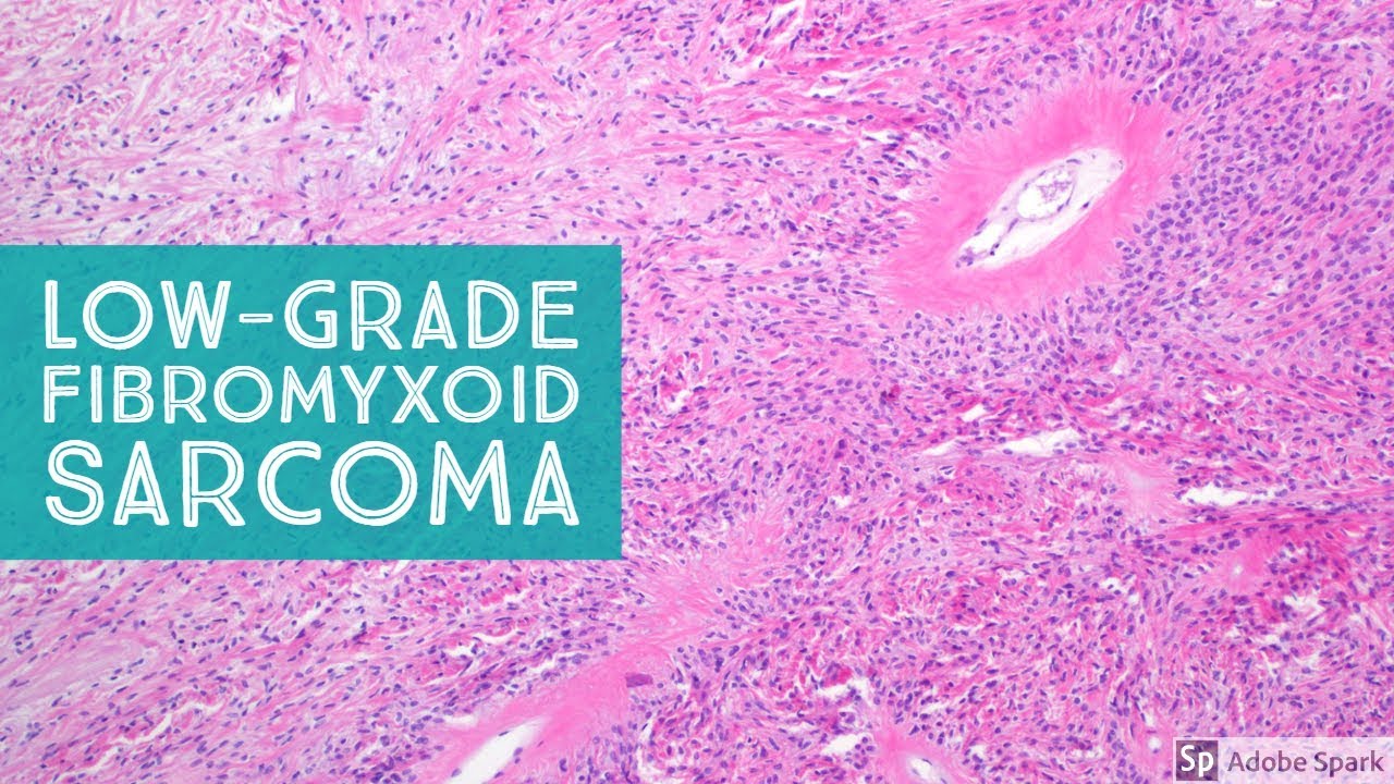 cancer sarcoma fibromyxoid