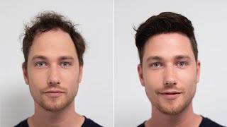 Hereditary Hair Loss in Men I Transformation with Hairsystem I Hairsystems Heydecke