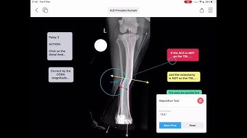 What are the principles of angular limb deformity correction? An explanation in vPOP-pro