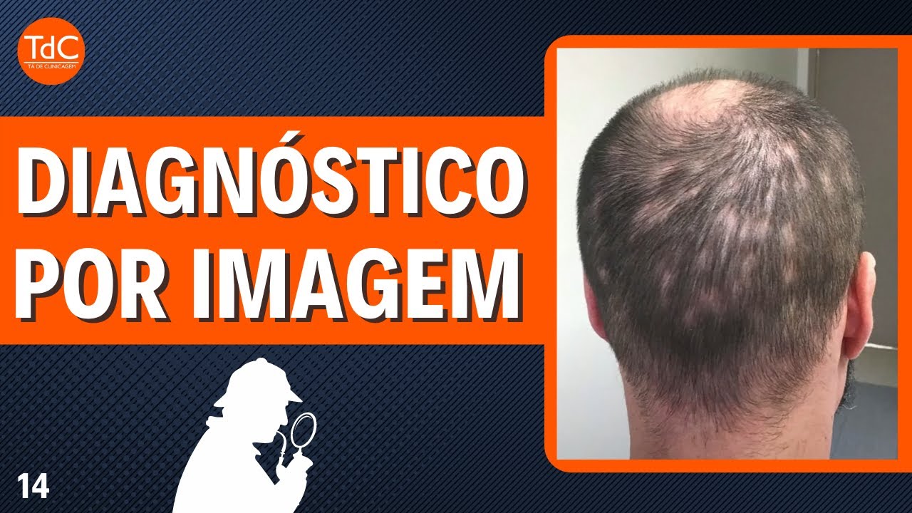 Thumbnail - " Máculas eritematosas pelo corpo e Alopécia" l Desafio TdC 14