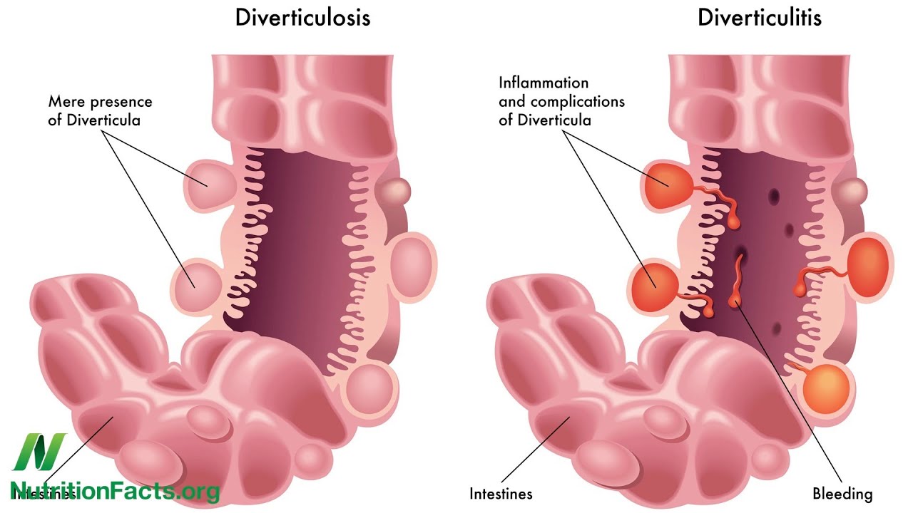 Q tomar para inflamacion intestinal