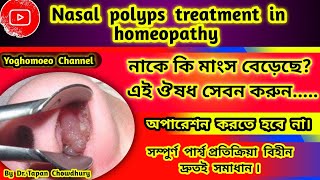নাকের পলিপাস দূর করার হোমিওপ্যাথি চিকিৎসা । homeopathic medicine for nasal polyps treatment