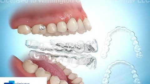 Invisible Aligners Elastics Class III