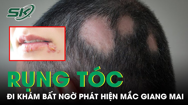 Rụng tóc ở nam giới là bệnh gì năm 2024