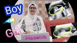 Q/As | Anterior Placenta means baby Girl | Posterior Placenta means baby Girl/Boy | Fundal Placenta