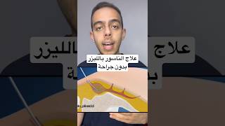 علاج الناسور بالليزر بدون جراحة #طب #medicine #shorts