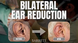 Natural Looking Ear Reduction From Start To Finish! | Barrett
