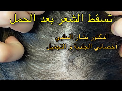 فيديو: ماذا تفعل إذا تساقط الشعر بعد الولادة