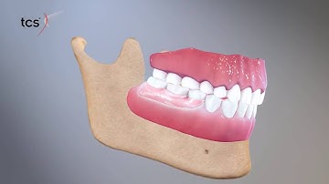 TCS Flexible Partial Dentures Animation Video online video cutter com