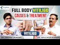 Full body vitiligo treatment in india  full body vitiligo       kayakalp global