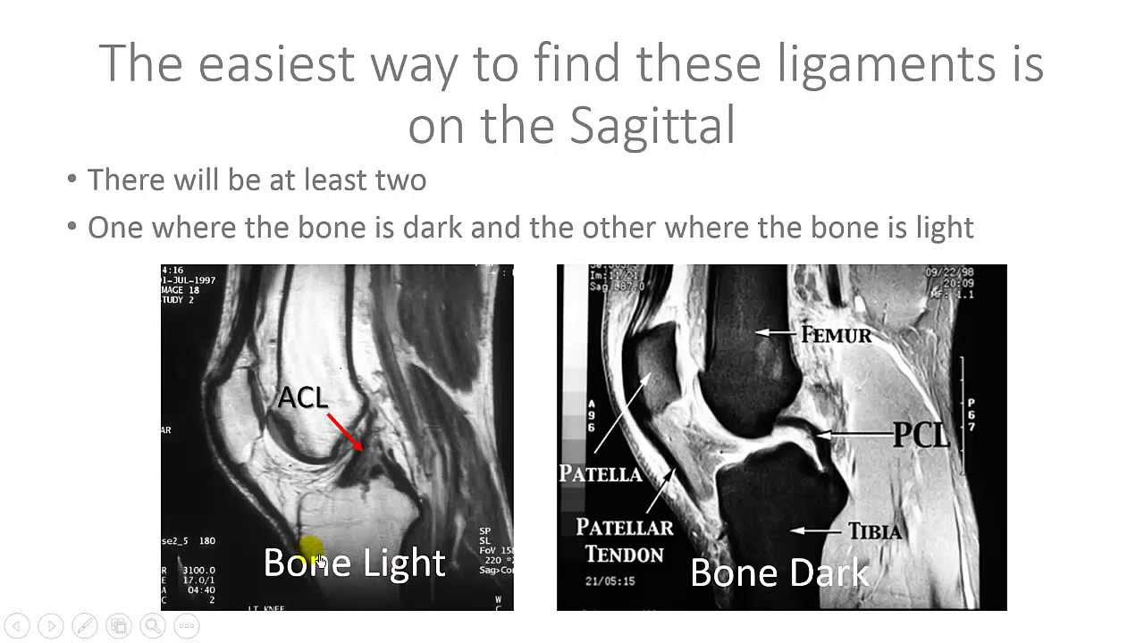 Update Read Knee MRI ACL and PCL - Help with Reading MRI