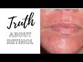 THE TRUTH ABOUT RETINOL WHAT YOUTUBE IS NOT TELLING YOU