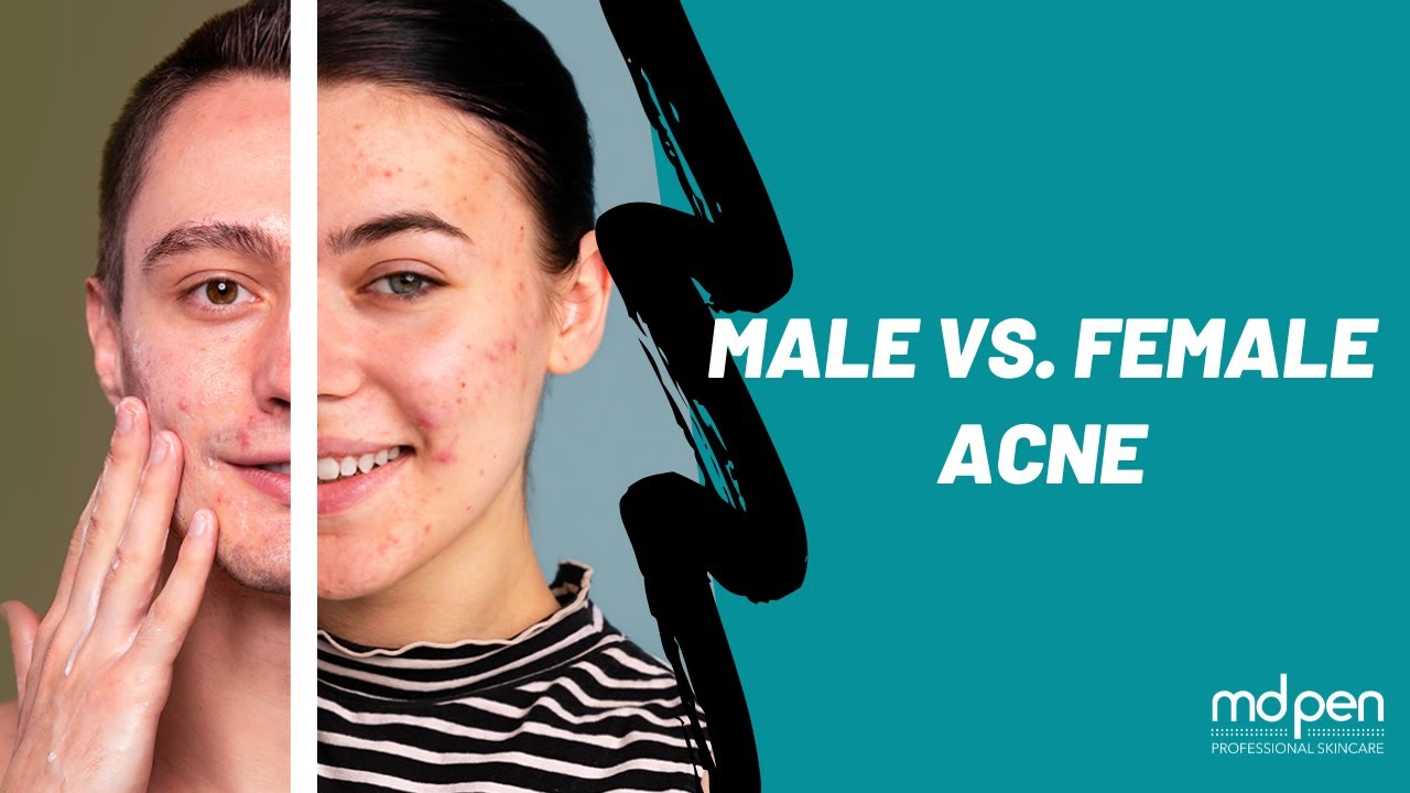 Male VS Female Acne YouTube male-vs-female-acne-youtube