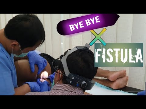 Perjalananku Mengidap Penyakit Fistula