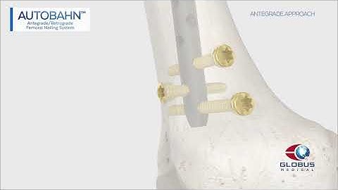 AUTOBAHN AR Femoral Nailing System Technique Animation
