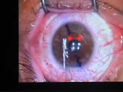 Opération laser de la myopie - YouTube