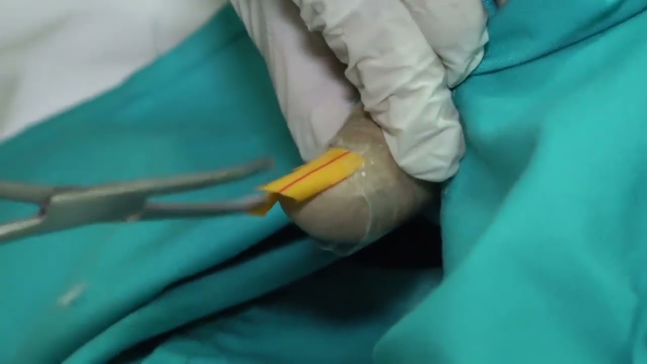 3. Blok indra khusus skill Ekstraksi Kuku   Dr  dr  Sri Vitayani Sp KK