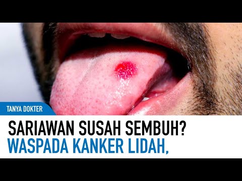 Sariawan dan Suara