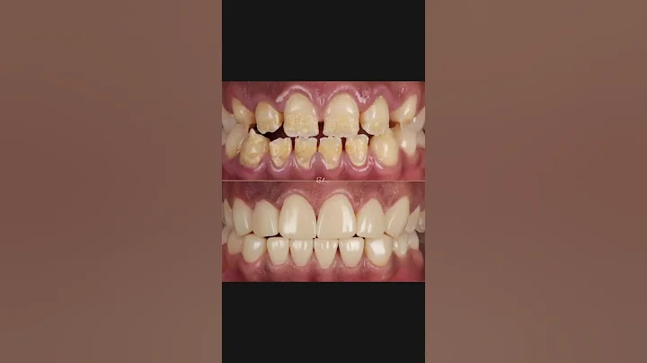 Composite bonding by Dr. Pete to change this patient’s life! 😍 #compositebonding #smilemakeover