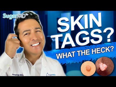 Skin Tags On Diabetics. Are They Dangerous? How to Get Rid of Them?