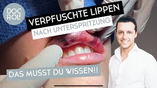 LIPPEN AUFSPRITZEN SCHIEF GEGANGEN - Dr. Rolf Bartsch