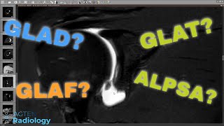 MRI of glenoid labral flap tear - a pathognomonic lesion (rare)